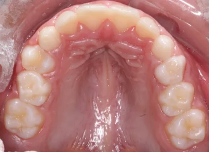 Después: arco dental alineado correctamente visto desde arriba