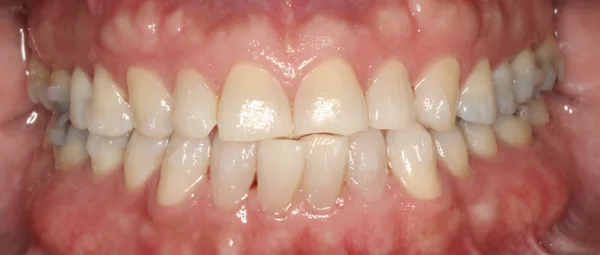 Antes: apiñamiento dental severo, dientes desalineados