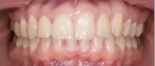 Antes: mordida cruzada y dientes desalineados