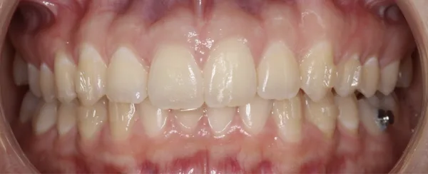 Después: mordida corregida y sonrisa alineada