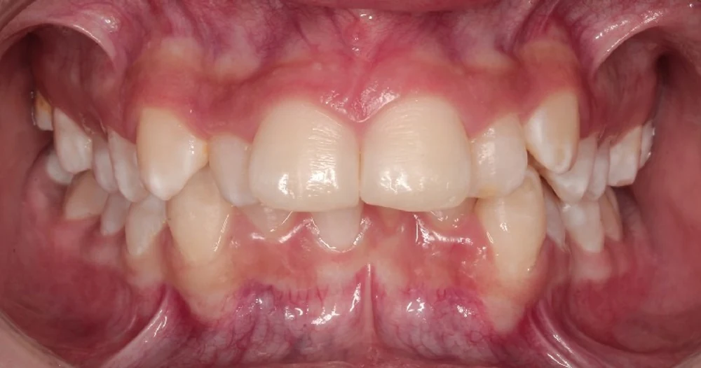 Antes: dientes de adelante apiñados y montados, vista de frente