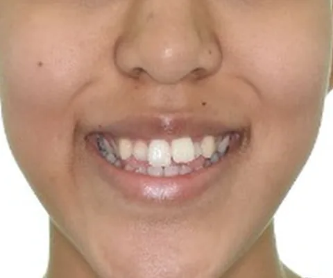 Antes: la sonrisa con los dientes de adelante desalineados