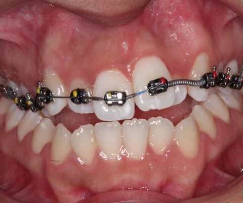 Durante: los brackets convencionales puestos, a mitad del tratamiento