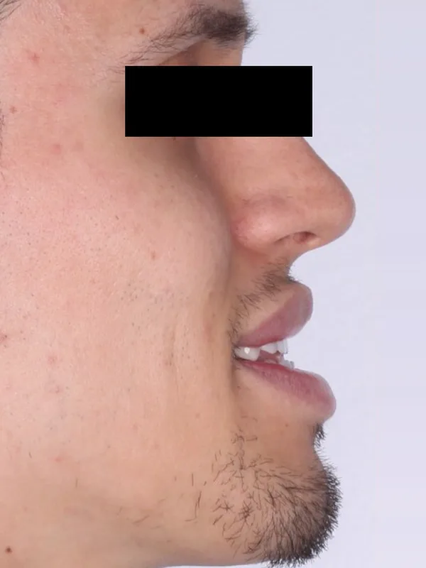 Antes: el perfil sonriendo, con los dientes de adelante separados y hacia afuera