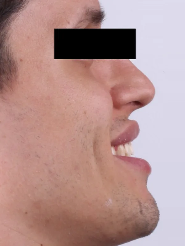 Después: el mismo perfil sonriendo, con los dientes de adelante alineados
