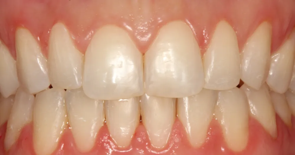 Después: los dientes alineados y la mordida cerrada al terminar con alineadores