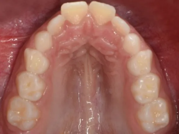 Antes: el arco de arriba visto desde abajo, con los dientes de adelante montados