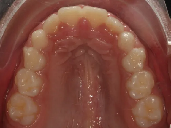 Después: el mismo arco, más amplio y con los dientes de adelante alineados
